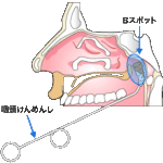 上咽頭の場所（ここに塩化亜鉛またはルゴール液を擦り付ける）